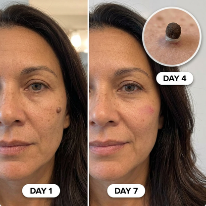 Complete Skin Tag Removal Kit 2.0