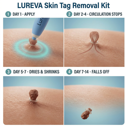 Complete Skin Tag Removal Kit 2.0